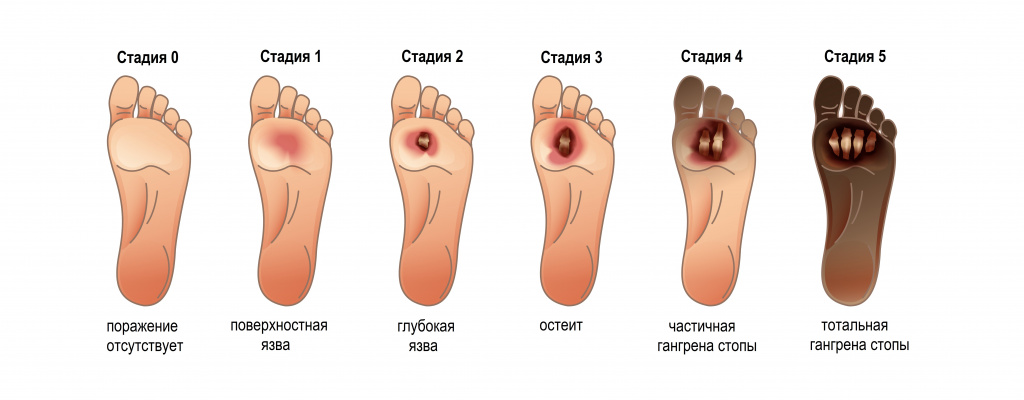 Критическая ишемия нижних конечностей, лечение, особенности